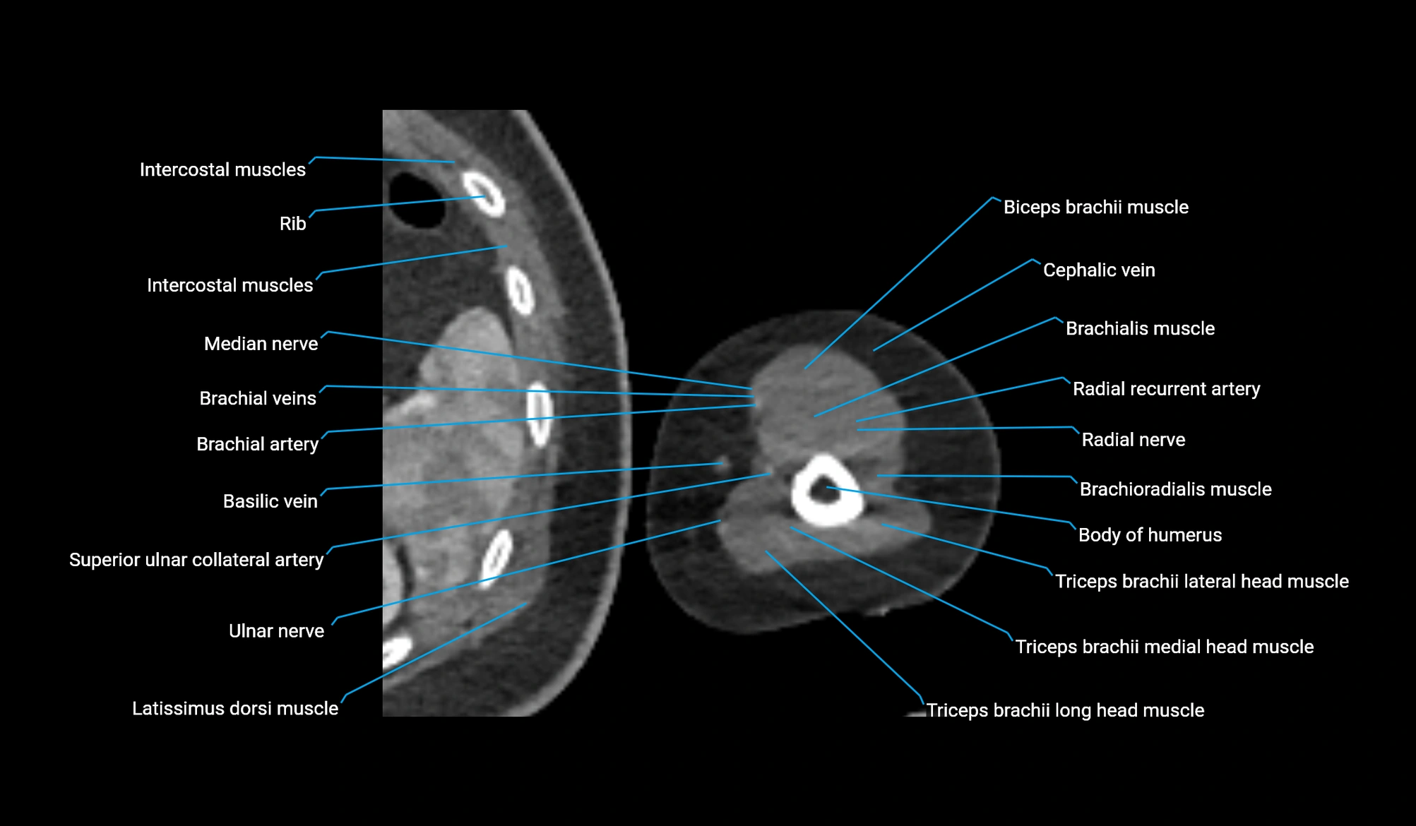 CT upper arm axial  cross sectional anatomy labelled radiology image -00318.webp